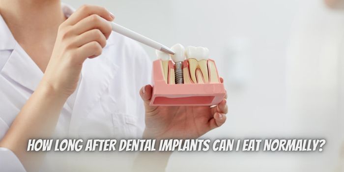 How Long After Dental Implants Can I Eat Normally?